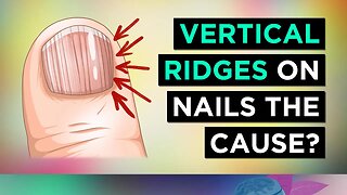 The REAL Causes of VERTICAL RIDGES On Your Nails