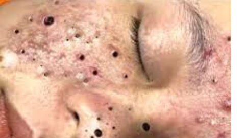 Big Cystic Acne Blackheads Extraction Blackheads & Milia