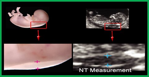 10. Ultrasound - Early Pregnancy