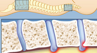 Understanding Peripheral Neuropathies Spinal Stenosis Dr Joel Wallach