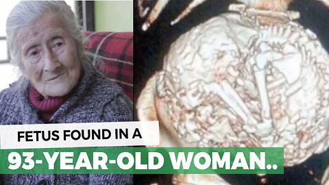 For 60 Years She Thought It Was A Tumor, Doctor Finally Tells Her The Truth