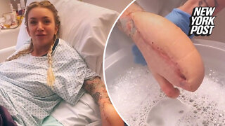 Woman left with 'shark hand' after doctors sew it inside stomach during surgery