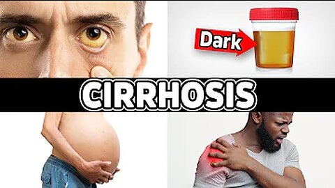 7 Warning Signs of Cirrhosis (End-Stage Liver Disease)