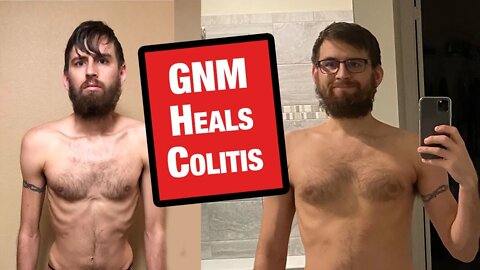 GNM Heals Impossible Case of Ulcerative Colitis