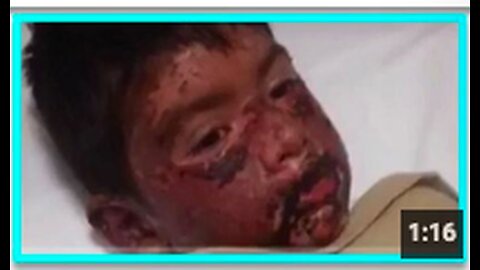 8 year old boy suffers horrific PFIZER VAXX induced injuries