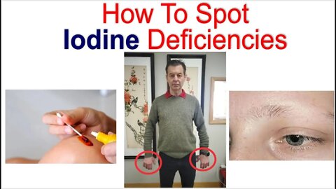 How To Spot Iodine Deficiencies
