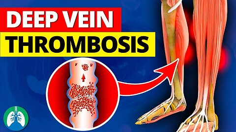 Deep Vein Thrombosis (DVT) | Quick Medical Overview