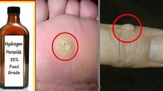 How To Easily Remove Warts And Skin Tags With Hydrogen Peroxide