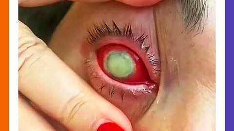 Recalled Eye Drops Causing Blindness 🟠⚪🟣 NPC Parents