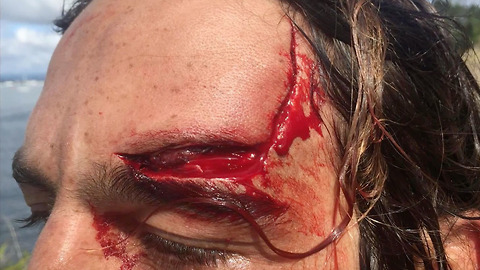 Trav McCoy's Nasty Surfing Head Injury Reveals Brain Tumor