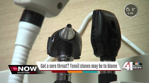 Tonsil stones becoming more common