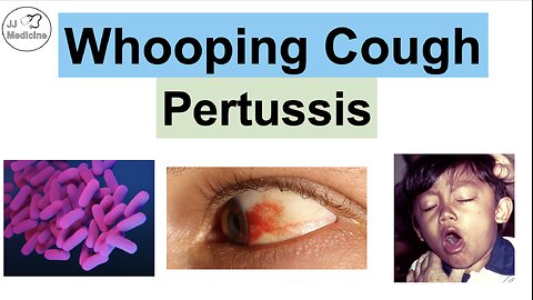 Whooping Cough (Pertussis) | Transmission, Pathophysiology, Symptoms, Diagnosis, Treatment