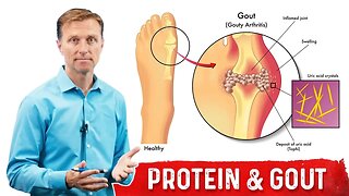 Why Does Dietary Protein NOT Cause Gout? – Dr.Berg