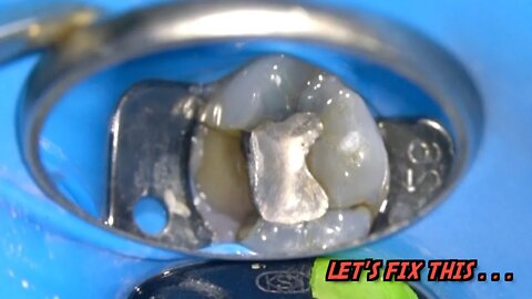 LIVE: Molar Root Canal Treatment | Tooth Decay BENEATH Silver Filling. . .
