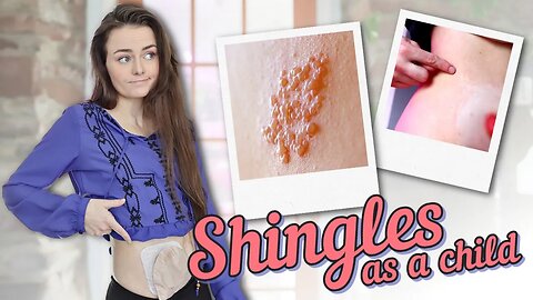 Diagnosed with Shingles (Shingles Symptoms & Scars) | Let's Talk IBD