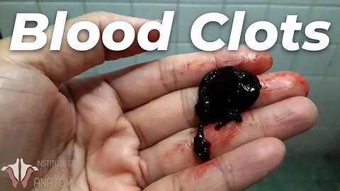 What You NEED to Know About Blood Clots...