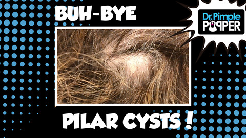 Buh-Bye Pilar Cysts!