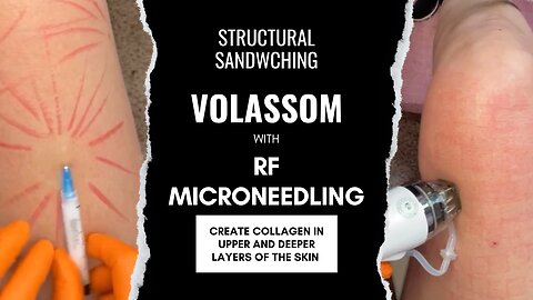 Structural Sandwiching using Volassom & RF Microneedling