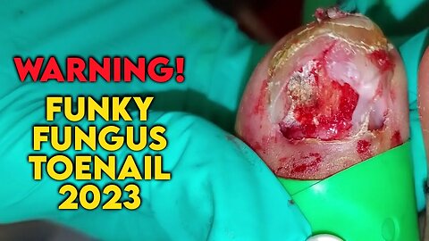 WHAT'S GOING ON HIS TOENAIL? ***FUNGAL NAIL INFECTION*** BY FOOT DOCTOR MISS FOOT FIXER 2023