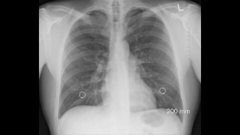 Common Asthma Medication Reverses Covid19!