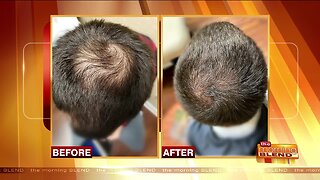 Proven and Permanent Hair Restoration Treatments