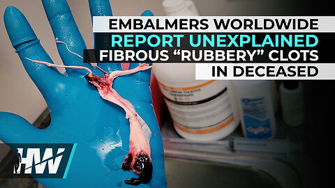 EMBALMERS WORLDWIDE REPORT UNEXPLAINED FIBROUS “RUBBERY” CLOTS IN DECEASED