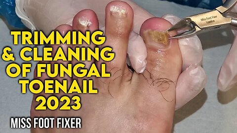 TRIMMING & CLEANING OF FUNGAL TOENAIL 2023 [ SATISFYING ] BY FOOT DOCTOR MISS FOOT FIXER