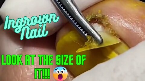 Ingrown Nail - Look at the Size of It!!! 😱😱