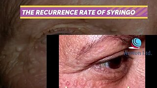 THE RECURRENCE RATE OF SYRINGOMA