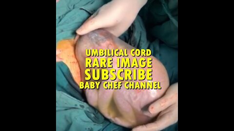 BABY BORN RARE FANTASTIC IMAGE THE UMBILICAL CORD