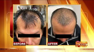 Hair Restoration Options for Men and Women