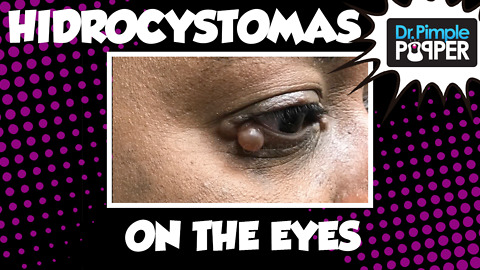 Hidrocystomas on both eyes!