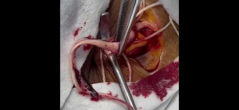 RICHARD HIRSCHMAN REMOVING ONE OF THE WHITE FIBROUS CLOTS