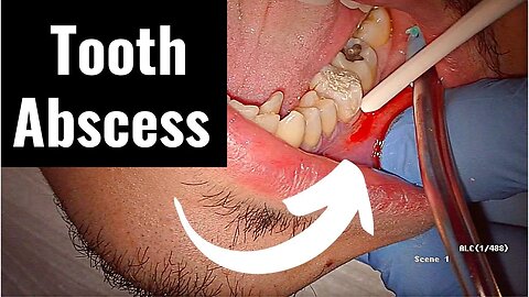 Incision and Drainage of Tooth Abscess Draining Pus