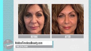 Makeover Mondays: Holden Timeless Beauty Discusses Liquid Facelifts