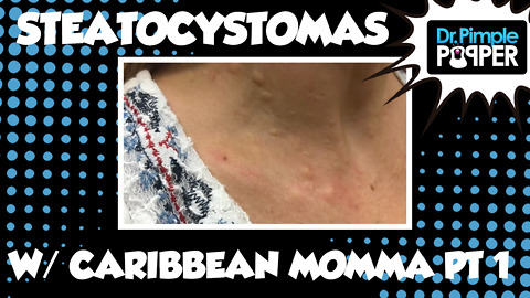 Caribbean Momma & Her Steatocystomas! Session One, Part One