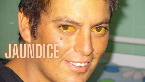Jaundice: What It Is and How It Works!