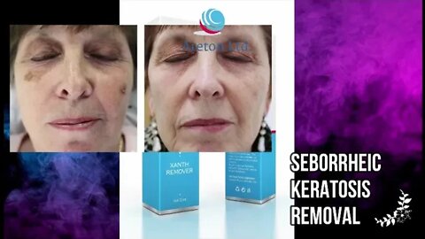 Anti Aging Spots, Dark Spots, Age Spots Removal Glycolic acid Cosmetic peel XanthRemover