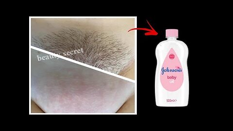 Baby oil is stronger than laser, it permanently removes facial, body and pubic hair.