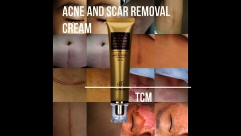 #Shorts: Acne and Scar Removal Cream-Affiliate Marketing shorts video
