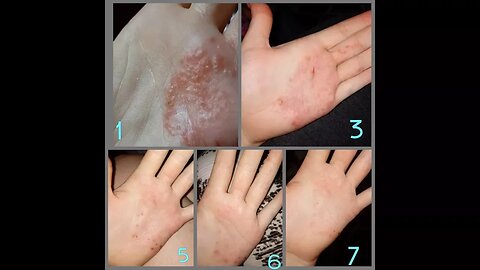 HOW TO CURE ECZEMA IN DAYS!