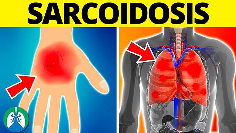 Sarcoidosis (Medical Definition) | Quick Explainer Video