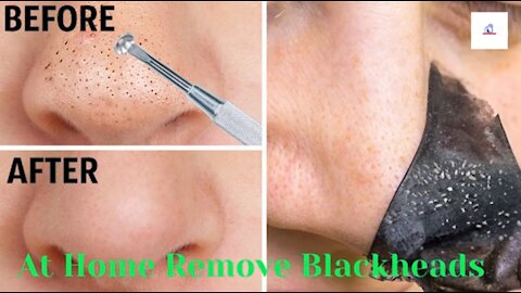 At Home Remove Blackheads