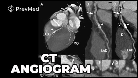 CT Angiogram - It's Better Than Stress Tests