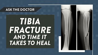 Ask the Doctor: Tibia fracture and time it takes to heal