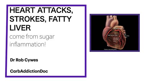 CarbAddictionDoc 2: HEART ATTACKS, STROKES, FATTY LIVER...come from sugar inflammation