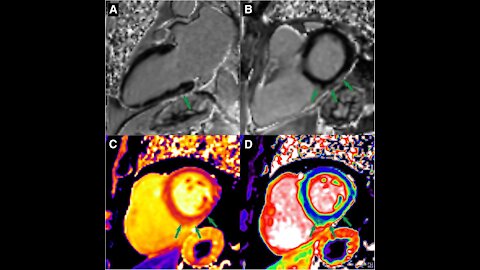 Doctor speaks about myocarditis