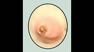 78. Breast Engorgement - Mastitis - Homeopathy
