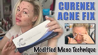 Curenex Acne Fix using a Modified Meso Technique, AceCosm | Code Jessica10 Saves you money