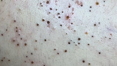 Big Cystic Acne Blackheads Extraction Blackheads Whiteheads Removal Pimple Popping Vol 1